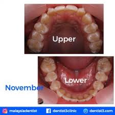 Maybe you would like to learn more about one of these? Uncategorized Archives Page 3 Of 7 Dentist Malaysia