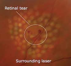 If your retina gets torn, the fluid inside your eye can leak underneath and. Retinal Detachment Tears New England Retina Associates