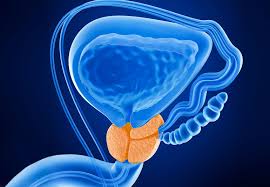 Prostate cancer is a common type of cancer in men, according to the mayo clinic. The Future Of Prostate Cancer Screening Cleveland Clinic
