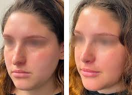 How soon can i exercise after having a nose job? Female Rhinoplasty Best Rhinoplasty Los Angeles