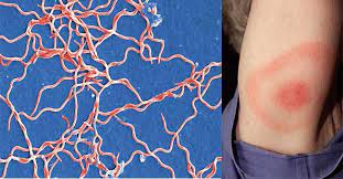 Check spelling or type a new query. Pathogenesis And Clinical Manifestations Of Borrelia Burgdorferi