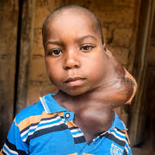 Daniels Tumor ist tödlich » Bitte hilf & spende