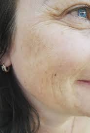 Image result for Melasma