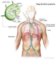 Adult Non Hodgkin Lymphoma Treatment Pdq Patient Version National Cancer Institute