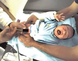 Image result for Neonatal Circumcision