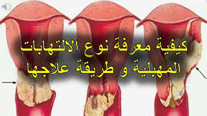 كيفية معرفة نوع الالتهابات المهبلية و طريقة علاجها Youtube