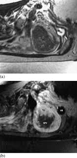Fansong mirena küng «mirena go go go» de dank goht bsonders a: New Interventional Techniques For Adenomyosis Sciencedirect