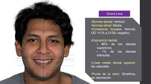 CASO CLÍNICO EXODONCIA