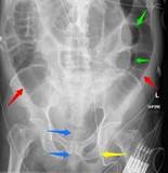 Image result for icd 10 code for small bowel dilatation
