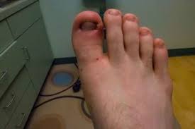Image result for Toenail Removal
