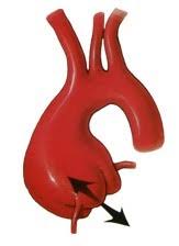 Maybe you would like to learn more about one of these? Operation Pour Anevrisme De L Aorte Thoracique En Chirurgie Cardiaque Lyon Annecy