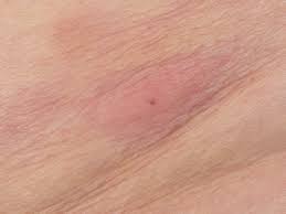 Iedereen kent wel iemand met rode uitslag in de natuurgeneeskunde zijn er verschillende mogelijkheden om de uitslag te verzachten. Eikenprocessierups Dermatitis