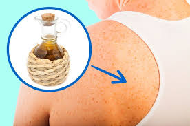 To remove small, uneven patches of self tanner, apply whitening toothpaste, rubbing alcohol, or acetone nail polish remover to the area and follow up with a good moisturizer. 11 Ways To Remove Dark Spots From Your Skin