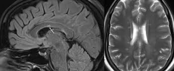 Image result for Brain Lesion