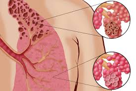Slideshow Reasons You Re Short Of Breath Shortness Of Breath Causes Respiratory Health Shortness Of Breath