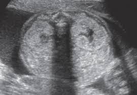 Autosomal Recessive Infantile Polycystic Kidney Disease Sciencedirect