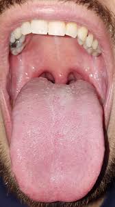 Though candida fungi live all over the body, if they become. Does This Look Like An Oral Yeast Infection Thrush Imgur