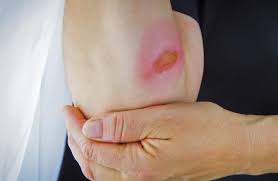 Check spelling or type a new query. Frequently Asked Questions About Burns How To Treat Heal Burns