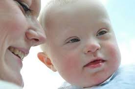 ما سبب ولادة طفل #داون لامرأة عشرينية ؟ الجواب: في الحقيقة أن العمر نفسه لا  يعتبر مانعا لولادة طفل مصاب بمتلازمة داون، ولكن الولادة بعد سن #الأربعين  تترافق مع نسبة أكبر في