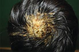 Like most fungal infections, armpit fungus is caused by skin fungi. Infections Infestations And Neoplasms Of The Scalp Intechopen