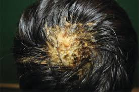 Find patient medical information for amoxicillin oral on webmd including its uses, side effects and safety, interactions, pictures, warnings and user ratings. Infections Infestations And Neoplasms Of The Scalp Intechopen