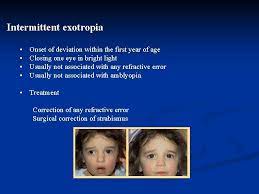 Strabismus Amblyopia Leukocoria Dr Hessah Alodan Pediatric Opthalmology