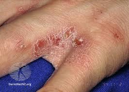 Image result for scabies human bites