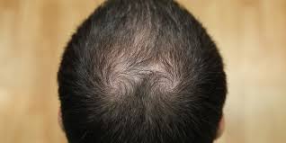 Sebopsoriasis refers to when someone has both dandruff and psoriasis. Itchy Scalp And Hair Loss Causes Treatments And Prevention Tips