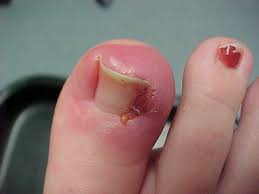 Wearing shoes that crowd your toenails 2. Big Toe Infection Symptoms Causes And Treatment Enkiverywell