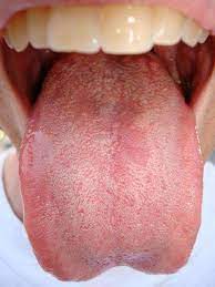 Diseases Treated By Prednisone Yeast Infection Treatment Yeast Infection Yeast Infection Medicine