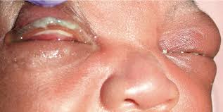 Image result for Gonococcal Conjunctivitis