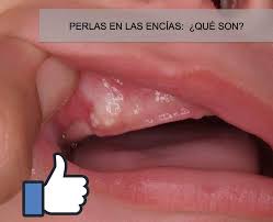 Odontopediatra Dra Ale Vela Cancino Perlas En Las Encias Que Son La Semana Pasada Dos Mamas Me Consultaron Preocupadas Porque Habian Visto En Las Encias De Sus Bebes Unas Cositas Blancas