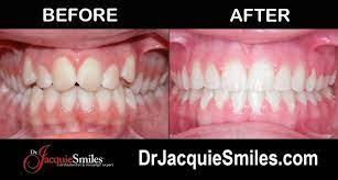 What Orthodontic Issues Can't Invisalign Correct?Dr. Jacquie