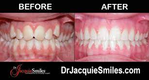 Others consider invisalign a cosmetic treatment unlike traditional braces. How Much Is Invisalign In Nyc Dr Jacquie