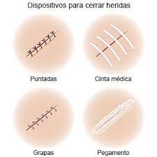 Cuidado De Los Puntos De Sutura Absorbibles Care Guide Information En Espanol