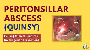 Image result for Peritonsillar Abscess