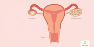 Endometrial hyperplasia bukanlah kanker, namun pada beberapa wanita kondisi ini dapat meningkatkan risiko. Kanker Ovarium Tanda Dan Gejala Penyebab Cara Mengobati Cara Mencegah