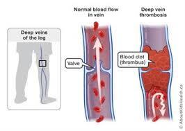 Check spelling or type a new query. Deep Vein Thrombosis