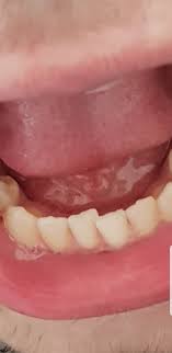 Zahnspange wann sind zahnspangen wirklich sinnvoll? Denkt Ihr Braucht Man Dafur Eine Feste Zahnspange Gesundheit Leben Angst
