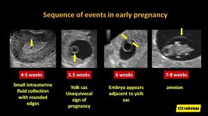 Image result for First Trimester Ultrasound