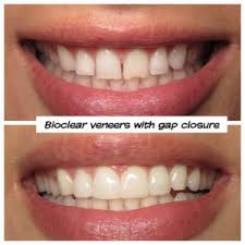But in reality, it is extremely common for children and adults to. Cost Of Bioclear With San Diego Cosmetic Dentist Dr David Eshom