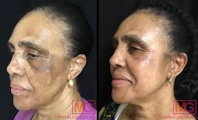 Post Laser Hyperpigmentation