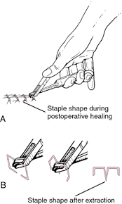 Remove the covering or bandage from your wound. Staple Definition Of Staple By Medical Dictionary