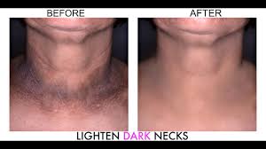 Maybe you would like to learn more about one of these? Dark Neck Home Remedies How To Get Rid Of Dark Neck Naturally In 5mins Omabelletv Youtube