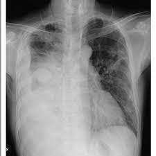 Camrsa necrotizing pneumonia and empyema are now more common in children. Consolidation And Collapse In The Right Lung With A Large Loculated Download Scientific Diagram