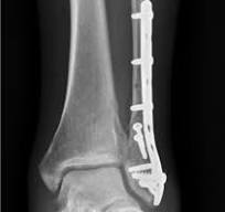 Anatomic pre-contoured locking plate with interfragmentary ...