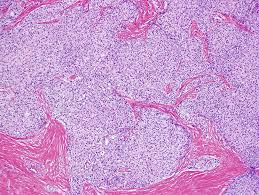 Adenocarcinoma cancers being usually in one of the following organs: Solid Trabecular Variant Of Papillary Thyroid Carcinoma Springerlink