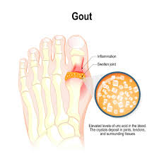Image result for gout