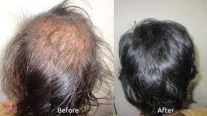 Scratching the scalp can damage the hair follicles, which obstructs natural hair growth and causes your hair to fall out. Dandruff Hair Disorders Clear Skin And Hair Laser Center
