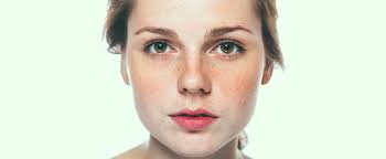 Best Makeup to Cover Rosacea